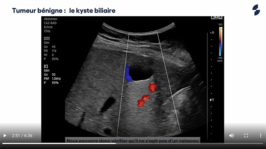 Chographie Du Foie Pathologies H Patiques