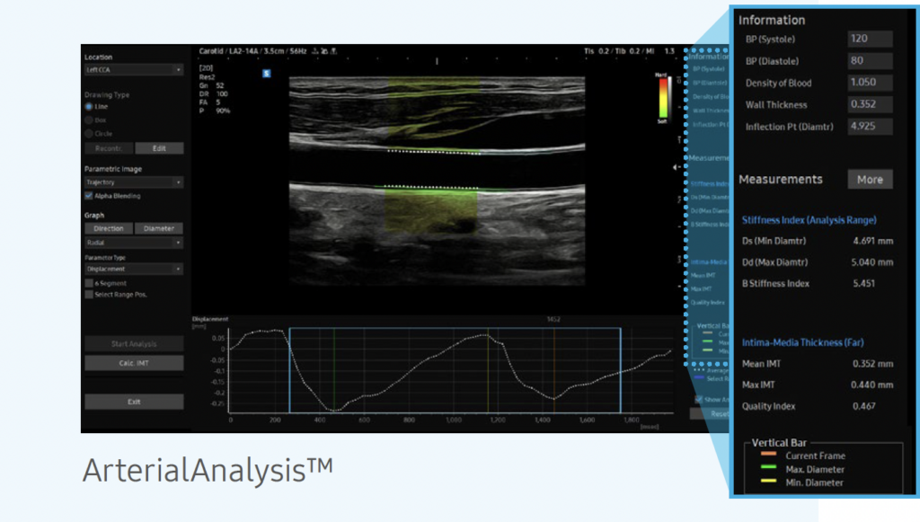 echographie_vasculaire_arterial_analysis