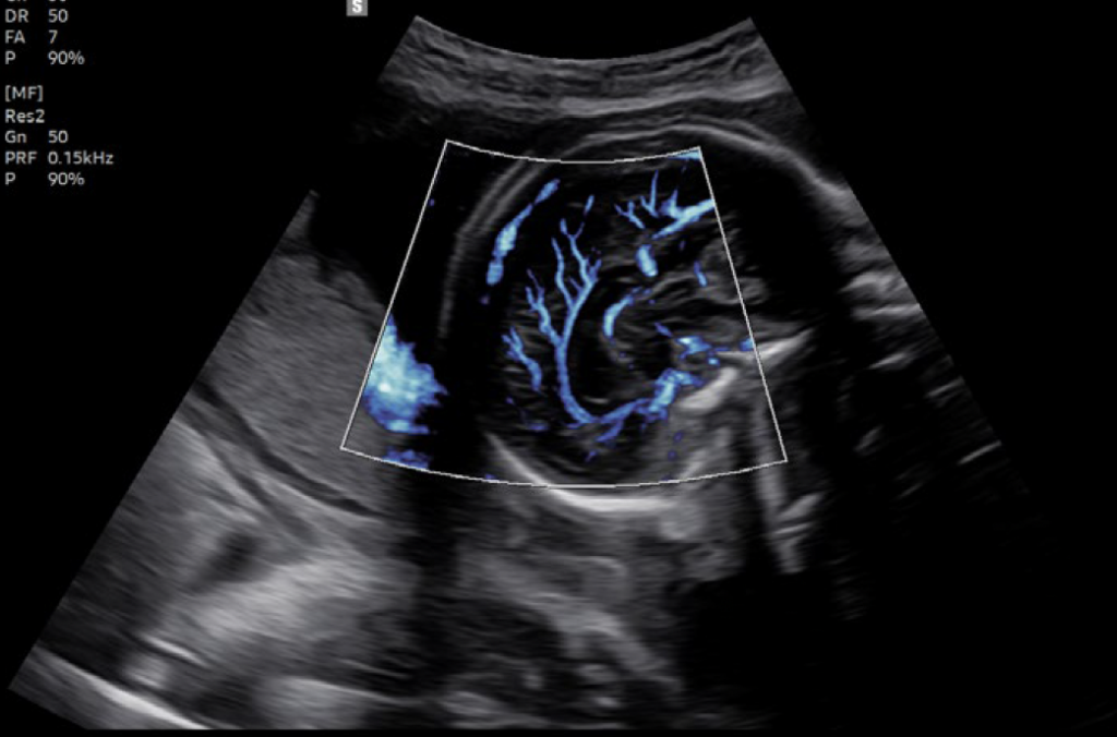 MV_flow_cerveau_foetal_v8