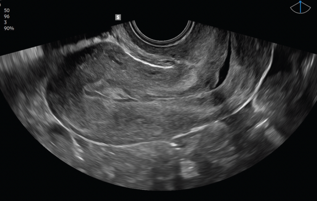 V5_uterus