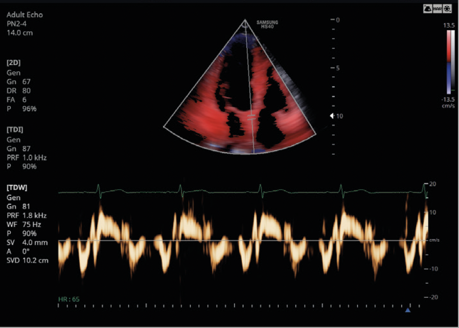 samsung_hs40_Doppler_tissulaire