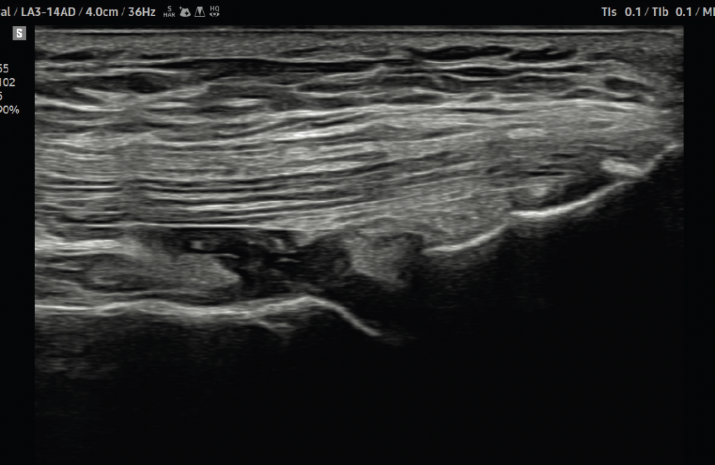 echographe_samsung_v5_tendon