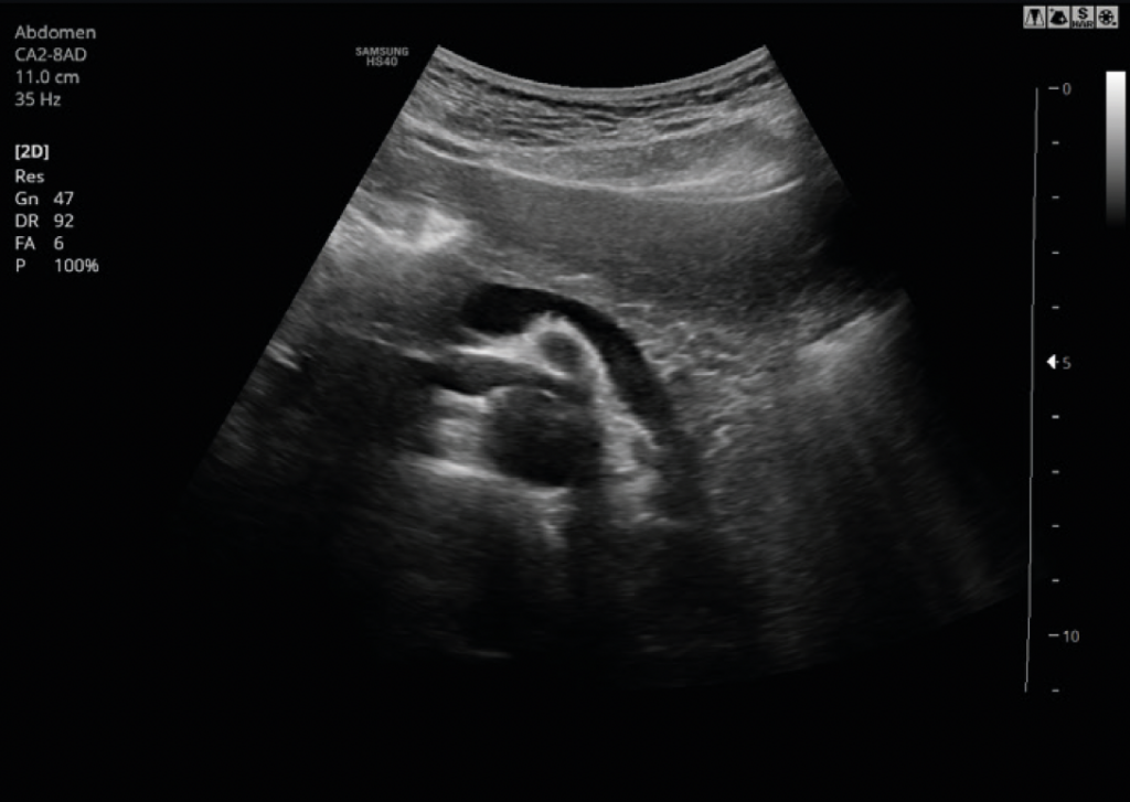 samsung_hs40_pancreas