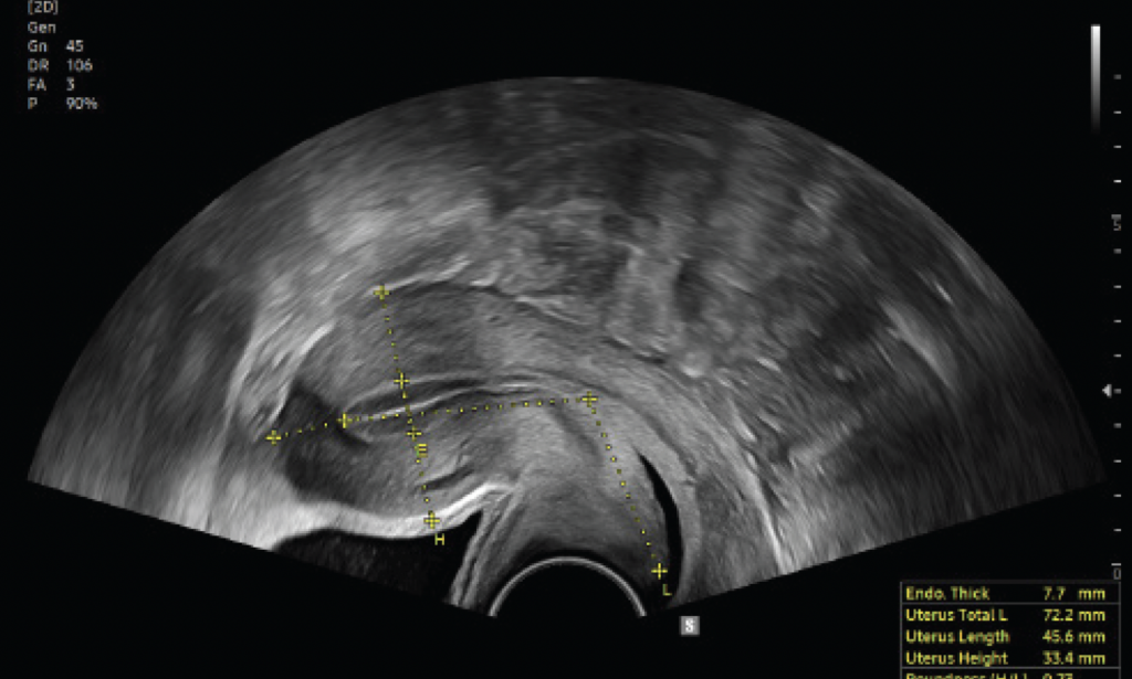 v6_uterine_assist