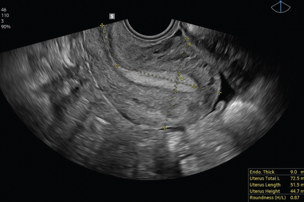 uterine_assist_V7
