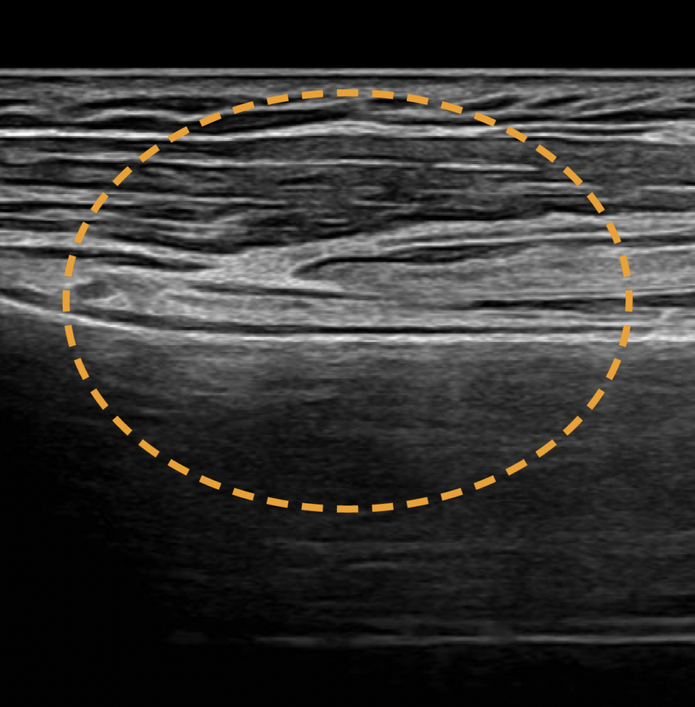 echographe_samsung_v7_tendon
