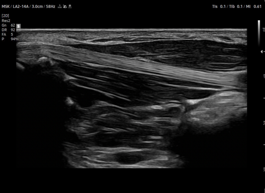 echographe_samsung_v7_tendon2