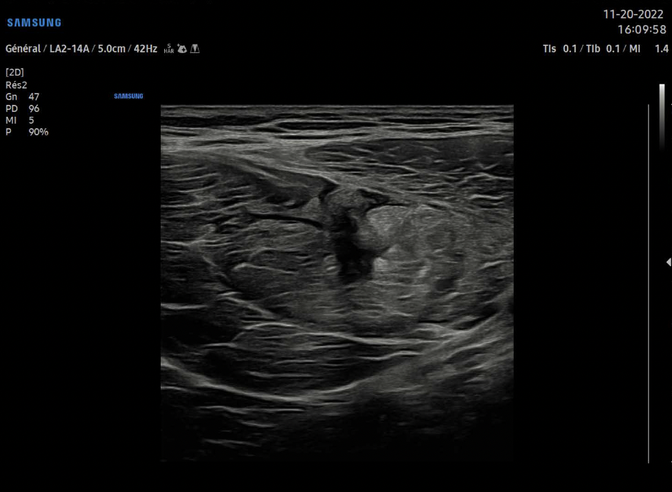 echographe_samsung_v7_lesion_musculaire