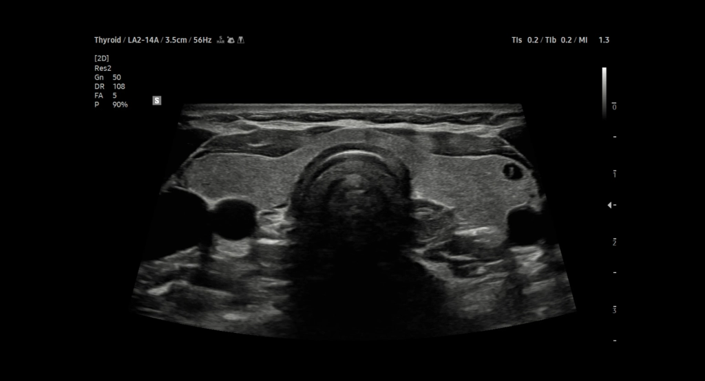 usa-samsung-gi-v8-thyroid-2d (1)