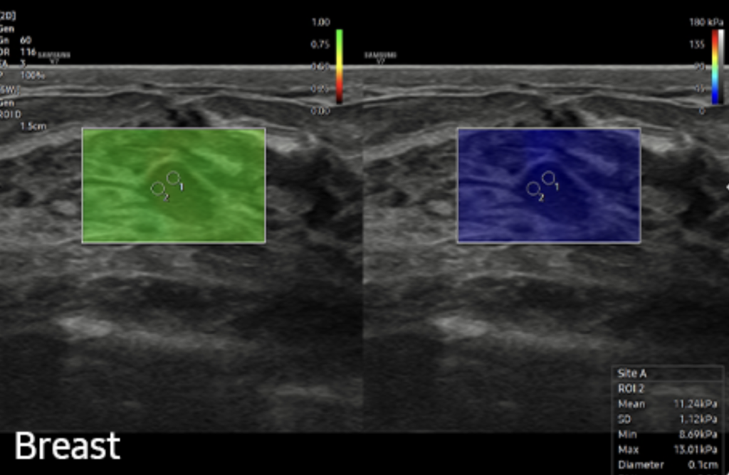 Samsung S-shearwave imaging quantification de la dureté tissulaire
