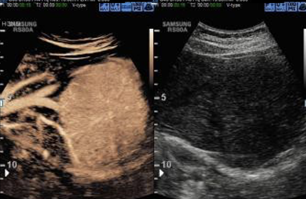 imagerie_de_contraste_echographie_ceus