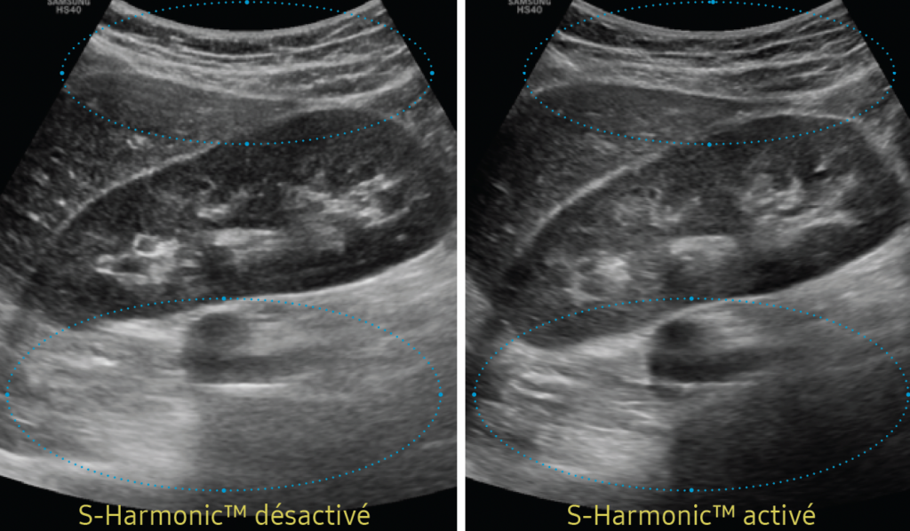 s_harmonic_echographes_samsung