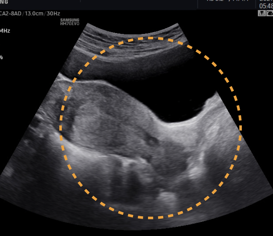 samsung_hm70_evo_uterus