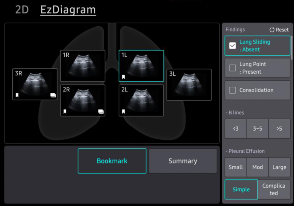 EZ diagram echographie pulmonaire samsung