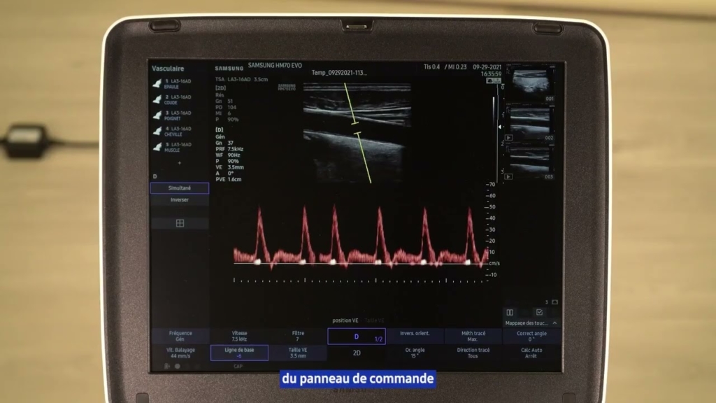 Miniature Samsung HM70 EVO tuto 06 Doppler Pulsé PW