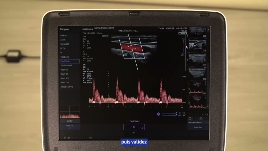 Miniature du tuto Samsung HM70 EVO tuto 08 Mesures Doppler en calipers simples Partie 2