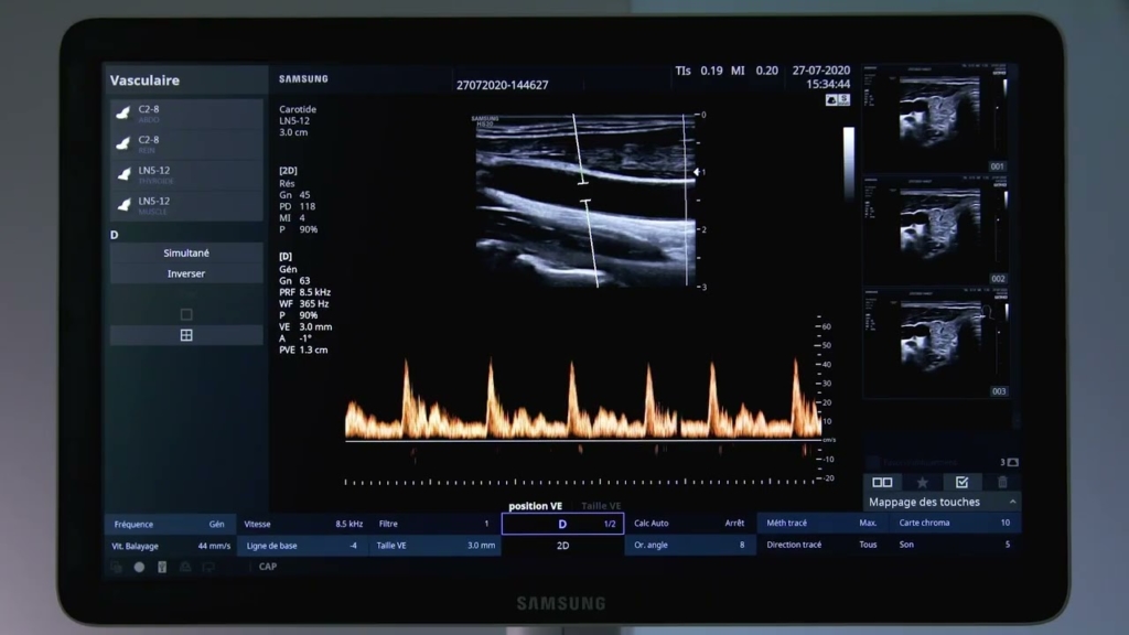 Miniature du tuto Samsung HS30 tuto 06 Doppler Pulsé PW