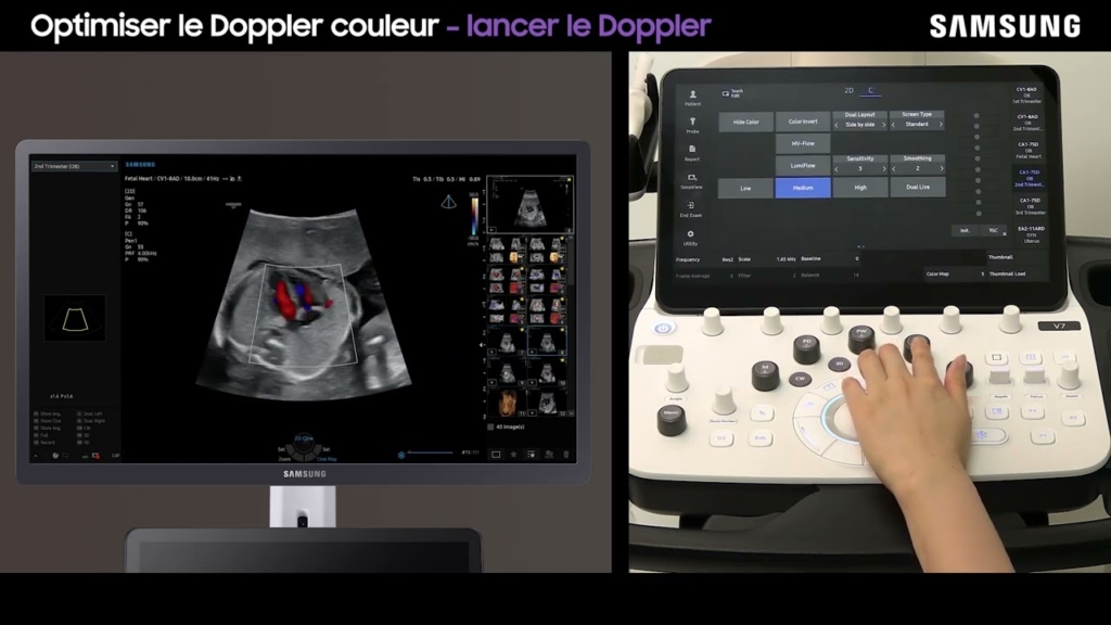 Miniature du tuto Samsung V7 tuto 04 Optimiser le Doppler couleur
