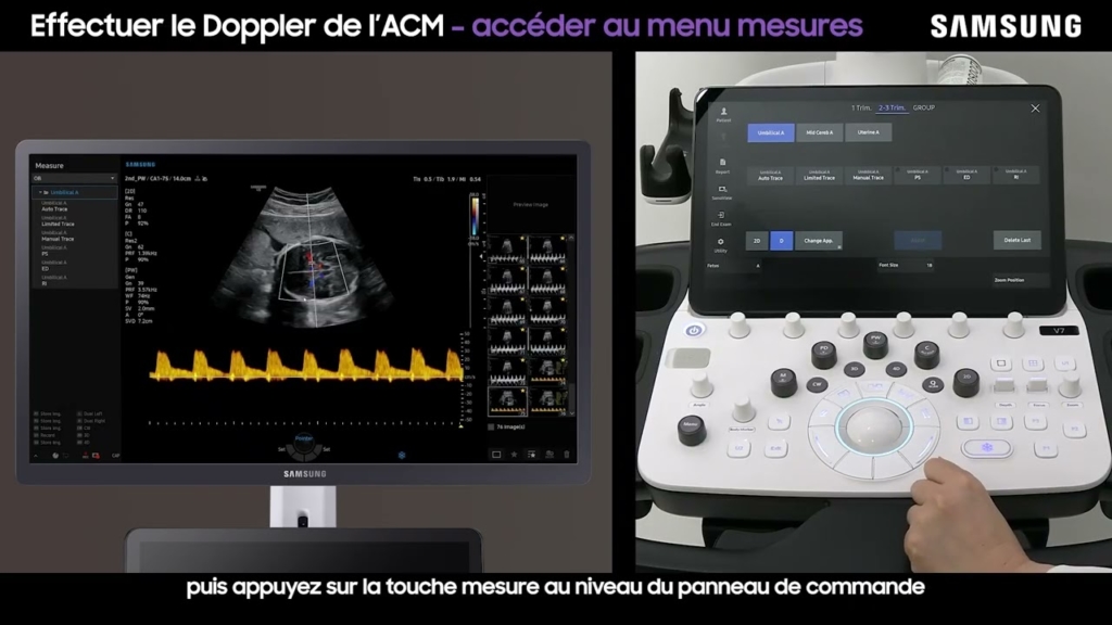 Miniature du tuto Samsung V7 tuto 05 Le Doppler de l'ACM en obstétrique