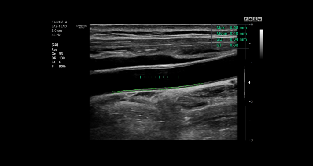 AutoIMT™ — Mesure de la fraction d'éjection du ventricule gauche