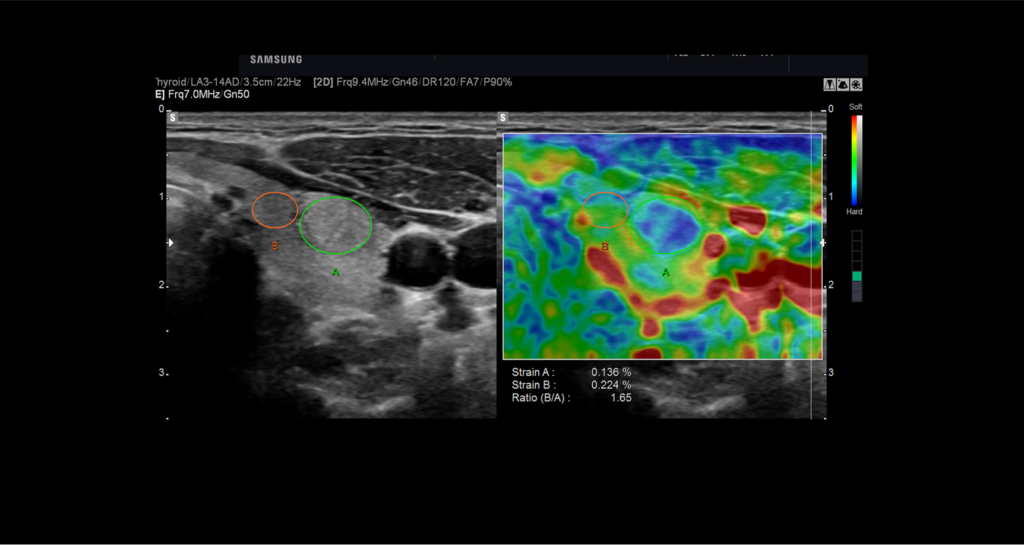 ElastoScan™ / E-Strain™ — Calcul du ratio d'élasticité entre deux zones d'intérêt