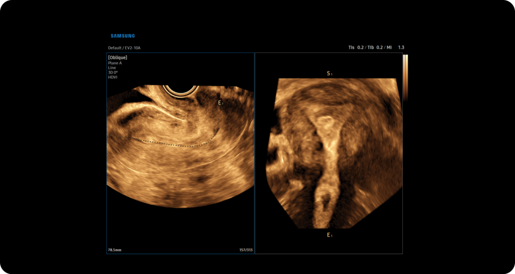 UterineContour™ — Reconstruction automatique de la coupe frontale de l uterus