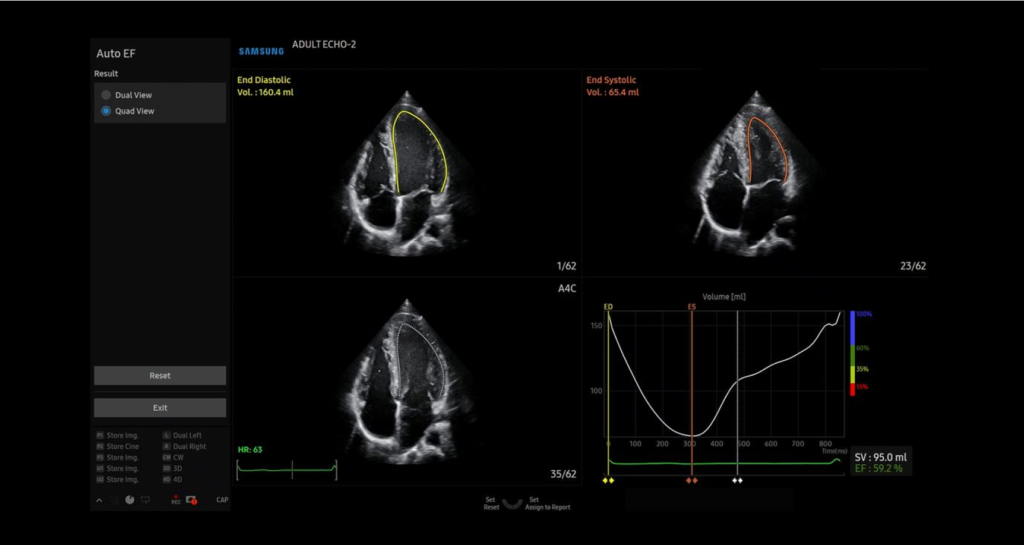 AutoEF™ — Mesure de la fraction d'éjection du ventricule gauche