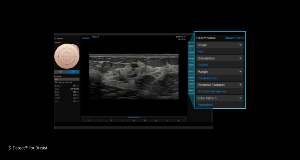S-Detect for Breast™ / BreastAssist™ / S-Detect™ — Analyse et rapport des lésions mammaires détectées