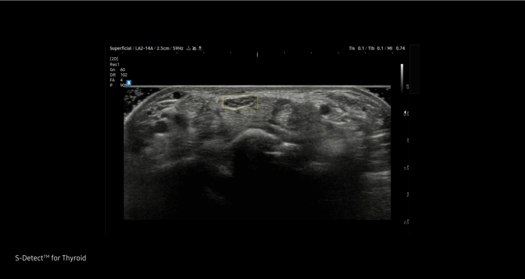 S-Detect for Thyroid™ — Analyse et rapport des lésions thyroidiennes détectées