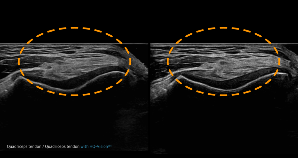 Luminant™ / Crystal Architecture™ / CrystalBeam™ / HQ-Vision™ / MultiVision™ — Clarification des zones floues de l'image