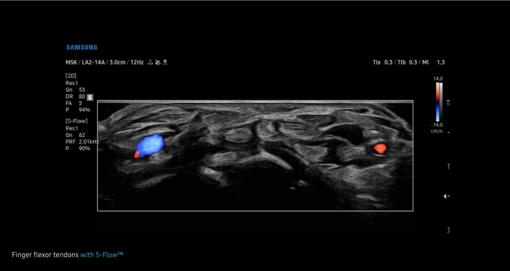 S-Flow™ — Examen des vaisseaux en Doppler Énergie bidirectionnelle