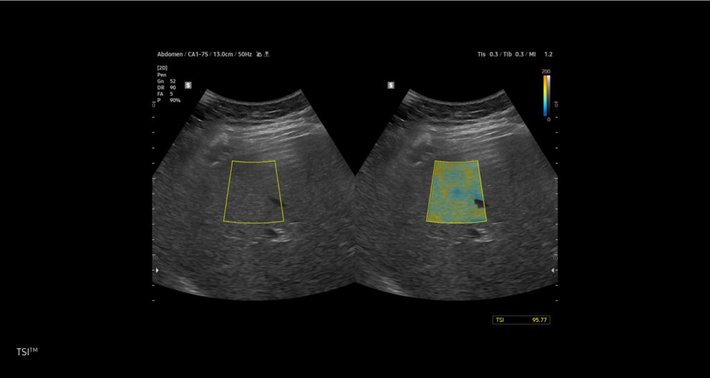 TAI™ / TSI™ / QUS™ — Mesure quantitative de la stéatose hépatique par ultrasons