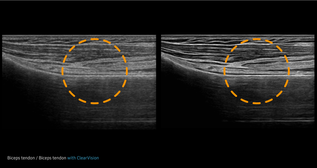 ClearVision™ — Reduction du bruit pour ameliorer la qualite d'image en 2d