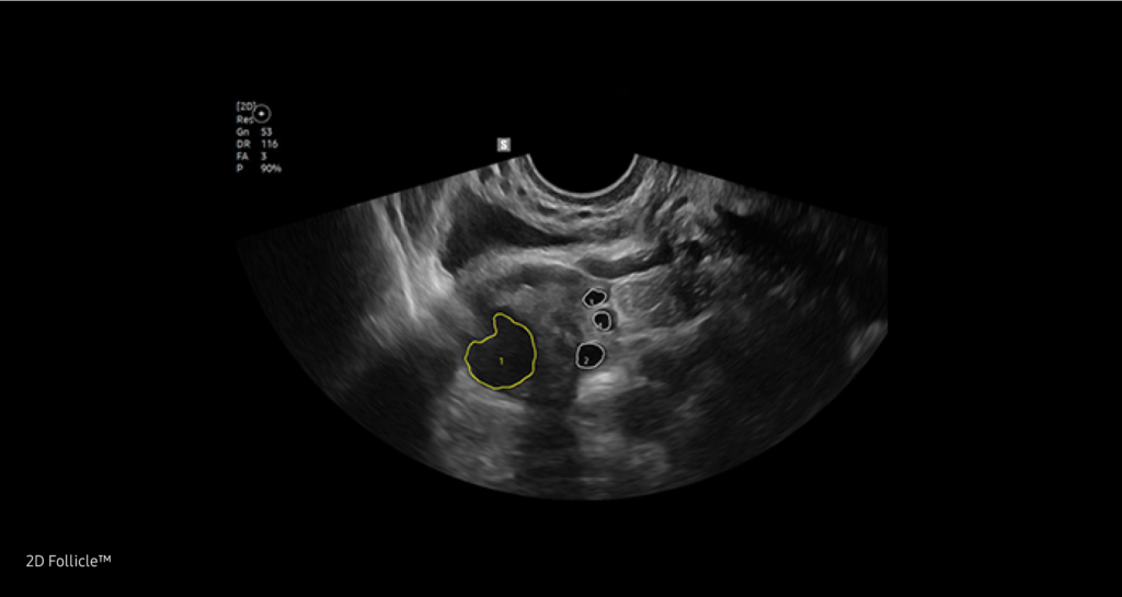 2D / 5D Follicle™ / 2D Follicle™ — Mesure 2d de la taille des follicules