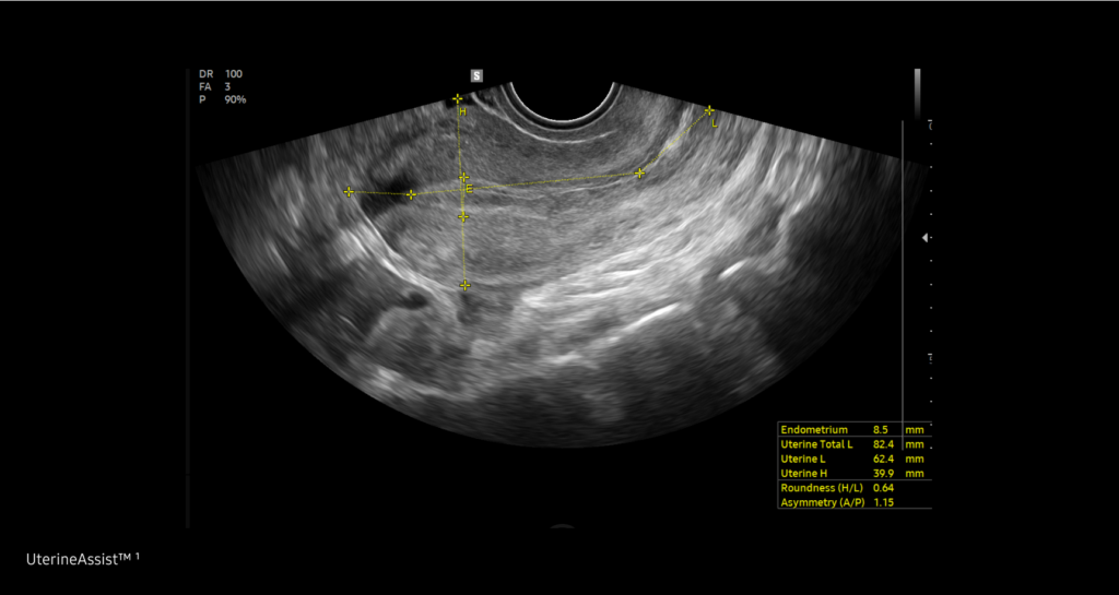 E-Cervix™ / UterineAssist™ — Mesure de la taille et de la forme de l uterus grace a la technologie ia