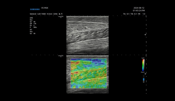 Samsung V5 - ElastoScan