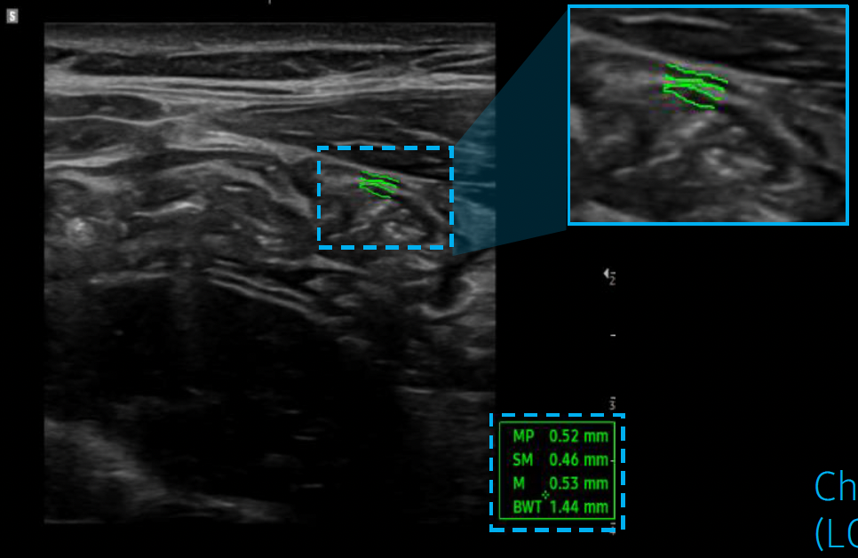 bowel_assist_echographe_samsung_evo_q10