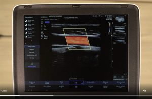 tutoriel échographe samsung HM70 EVO Doppler couleur