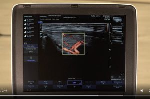 tutoriel échographe samsung HM70 EVO Doppler Puissance