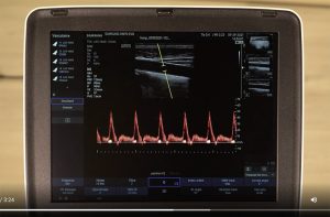 tutoriel échographe samsung HM70 EVO Doppler pulsé