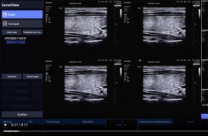 Tutoriel échographe samsung HS30 sonoview