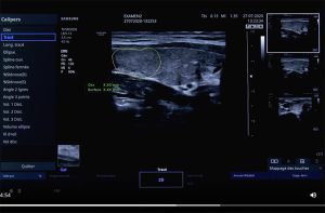 Tutoriel échographe samsung HS30 mesures
