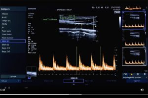 Tutoriel échographe samsung HS30 Doppler