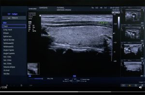 Tutoriel échographe samsung HS40 mesures