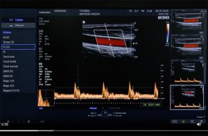 Tutoriel échographe samsung HS40 Doppler