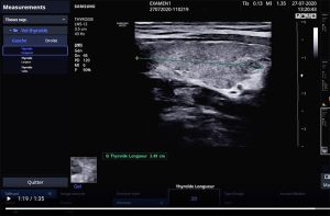 Tutoriel échographe samsung HS30 mesures protocolaires