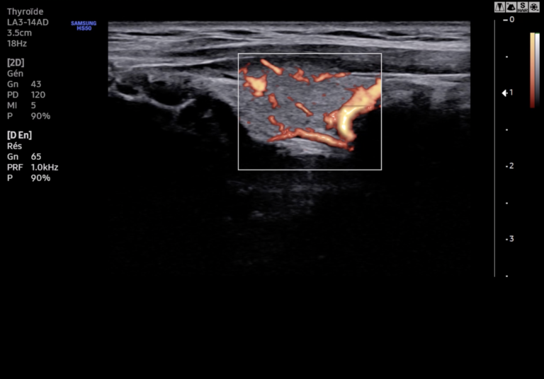 Echographe Samsung HS60 Thyroide S Flow