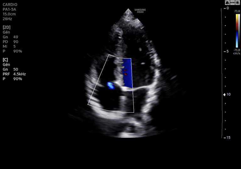 Echographe Samsung HS60 échocardiographie