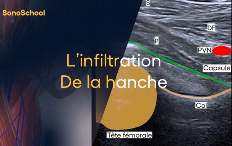 Infiltration sous échographie | Sonoschool x Jimmy Gross