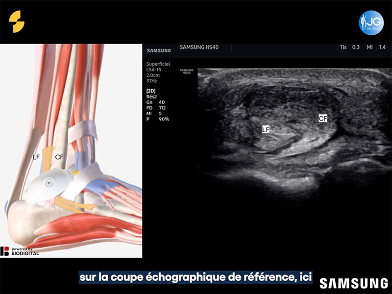 Infiltration de la Cheville sous Echographie | Sonoschool